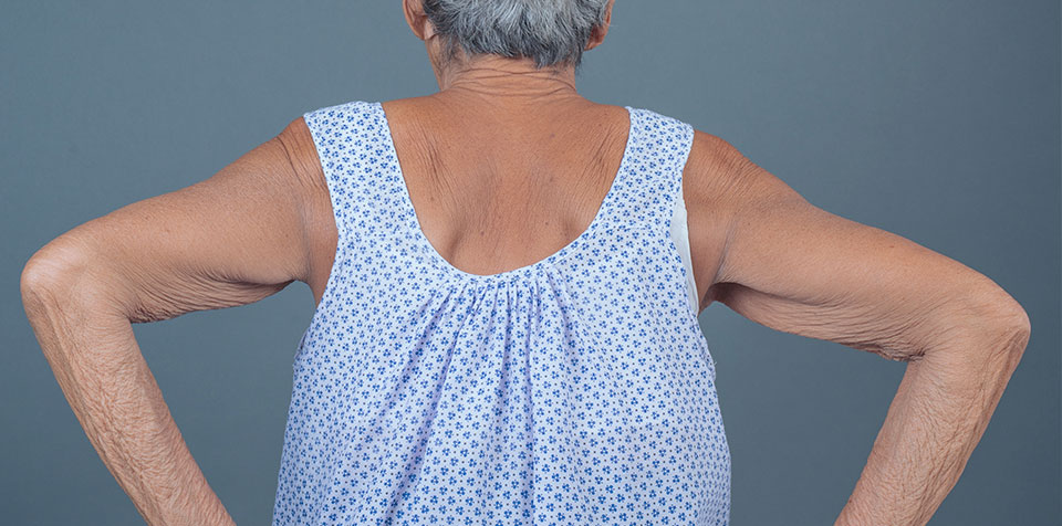 Sintomas da osteoporose: o que observar