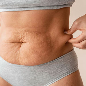 Lipodistrofia: o que é, causas e como o acúmulo irregular de gordura afeta sua saúde metabólica